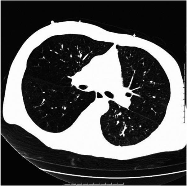 This diagnostic image is an axial chest computed tomography (CT) scan displayed in a lung window, showcasing the thoracic cavity at the level of the main bronchi. The primary findings are consistent with chronic obstructive pulmonary disease (COPD), specifically emphysema and chronic bronchitis. Both lung fields exhibit hyperlucency and attenuated vascular markings, indicative of parenchymal destruction. Notably, there are multiple large, thin-walled, air-filled spaces known as bullae scattered throughout both lungs. The bronchial structures show evidence of wall thickening and subtle dilation, suggesting associated chronic bronchitis and potential bronchiectasis. Areas of increased opacity representing fibrous foci are visible, reflecting underlying chronic inflammatory or scarring processes. The scan demonstrates the classic structural remodeling associated with long-term obstructive airway disease, including the presence of bullous emphysema. This visual material is intended for medical education regarding the radiological manifestations of end-stage chronic respiratory conditions and the identification of bullous disease on CT imaging.