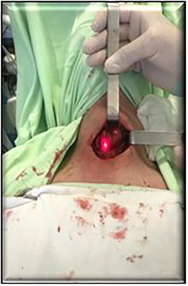 Clinical photograph of an intraoperative surgical setup during a neck procedure, likely a thyroidectomy or parathyroid surgery. The patient is in a supine position, draped with sterile green and white cloths showing minor blood staining around the surgical site. A gloved hand is using a metallic retractor to maintain exposure of the incision in the anterior neck. The surgical field is illuminated by a specialized near-infrared (NIR) spectrum light source, visible as a bright red-aiming beam, which is part of the SPY visualization system for indocyanine green (ICG) fluorescence angiography. This technology is utilized intraoperatively to identify parathyroid glands (PTG) and assess their perfusion before and after tissue resection. The image illustrates the integration of advanced fluorescence imaging into endocrine surgery for improved anatomical localization and preservation of delicate structures.