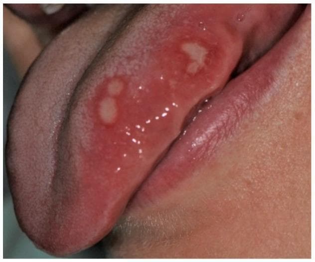 This clinical photograph shows a close-up view of the oral cavity focusing on the left lateral margin of the tongue. The image demonstrates minor aphthae, appearing as four discrete, oval-shaped ulcerations. Each ulcer is characterized by a central yellowish-whitish fibrinopurulent membrane that appears removable. A well-defined, prominent erythematous halo surrounds each lesion, signifying localized inflammation of the surrounding non-keratinized mucosa. The lesions are located on the ventral-lateral aspect of the tongue, a common site for recurrent aphthous stomatitis (RAS). This visual is representative of pediatric oral pathology, specifically illustrating the classic clinical presentation of minor aphthous ulcers in an adolescent patient. The morphology—small size, oval shape, and inflammatory border—is a key diagnostic feature for distinguishing these from other oral mucosal lesions like traumatic ulcers or herpetic stomatitis.