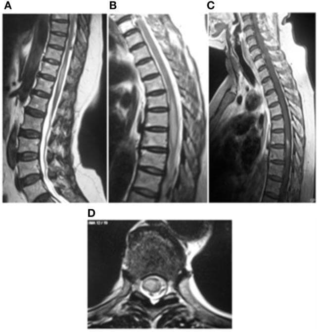 This diagnostic image set consists of MRI scans of the thoracic spine illustrating transverse myelitis. Panels A and B are sagittal T2-weighted images showing longitudinally extensive high signal intensity within the spinal cord, specifically spanning the T5-T7 and T10-T12 vertebral levels. These areas of hyperintensity are accompanied by mild cord swelling and enlargement, characteristic of inflammatory edema. Panel C presents a sagittal T1-weighted post-contrast image demonstrating focal enhancement within the affected cord segments, indicating a breach in the blood-spinal cord barrier. Panel D provides an axial view confirming the intramedullary location of the high signal intensity, which involves a significant cross-sectional area of the cord. These findings are clinically significant for diagnosing inflammatory or infectious myelopathies, such as spinal toxocariasis or idiopathic transverse myelitis, by identifying the extent of cord involvement and the presence of active inflammation through gadolinium enhancement.