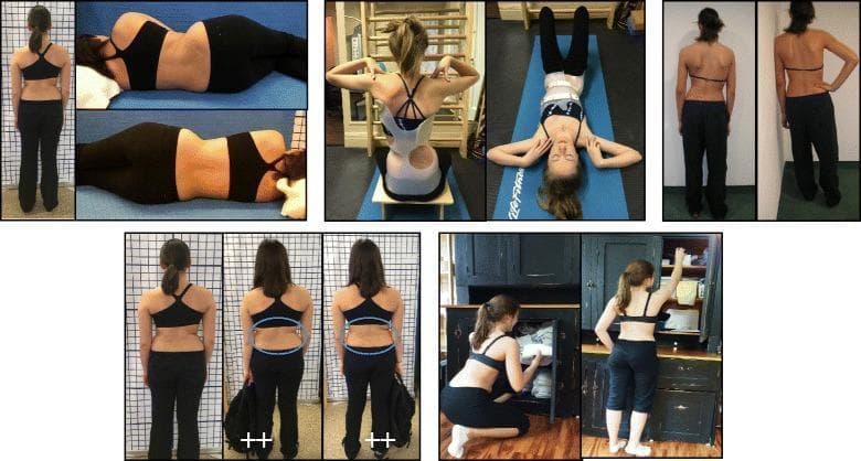 A multi-panel clinical photograph series documenting postural adaptations and therapeutic management in adolescent idiopathic scoliosis (AIS). The images illustrate patients in various positions relevant to activities of daily living (ADLs), including standing, side-lying (supine/prone variants), and sitting. Visible clinical features of scoliosis include lateral spinal curvature, uneven shoulder height, and waistline asymmetry. Several frames demonstrate the use of asymmetric rigid spinal braces (such as the ARTbrace or Rigo-Chêneau type), highlighting how the orthosis provides external corrective forces to improve truncal alignment and thoracic symmetry during rest and activity. Lower panels specifically depict ergonomic modifications for ADLs: carrying a bag with proper weight distribution (highlighted with blue ellipses for pelvic/waist alignment) and performing tasks like bending, lifting, and reaching. The content emphasizes the integration of Physiotherapy Scoliosis-Specific Exercises (PSSE), such as the BSPTS or Schroth methods, aiming to correct 3D spinal deformities through active self-correction and postural awareness training.