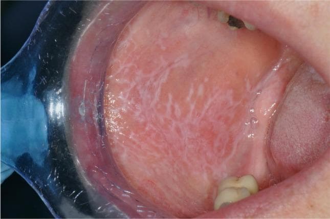 This clinical intraoral photograph demonstrates reticular oral lichen planus (OLP) on the buccal mucosa, categorized as a Thongprasom score 1. The primary visual finding is a network of delicate, white, lacy thread-like lines known as Wickham striae. These striae exhibit a classic arborescent or branching morphology against a background of slightly erythematous but otherwise intact mucosa. The lesion is well-distributed across the mucosal surface without evidence of ulceration, erosion, or significant atrophy, which is characteristic of the asymptomatic reticular subtype. Anatomical landmarks visible include the retracted labial commissure (using a clear plastic retractor), the maxillary and mandibular teeth, and a portion of the tongue. The image serves as a high-quality educational example of the classic diagnostic presentation of reticular OLP in oral medicine and dermatology, highlighting the distinction between white reticulated patterns and the more severe erosive forms of the disease.