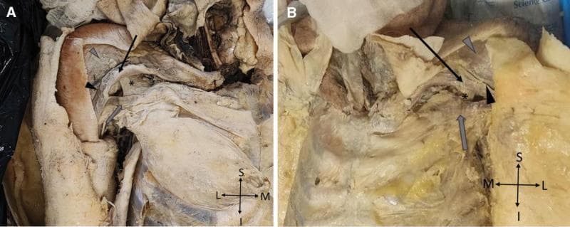 This medical image displays a comparative cadaveric dissection of the anterior thoracoappendicular region in two panels (A: right side; B: left side), illustrating anatomical variations consistent with bilateral partial agenesis of the pectoralis major (PMaj) and pectoralis minor (PMin) muscles. In both panels, the clavicular portion of the PMaj is identified by black arrows, and the sternocostal portion by gray arrows. An asterisk (*) marks the deep-seated PMin, which appears hypoplastic and blends with connective tissue. The deltopectoral sulcus (black arrowheads) is visible as a prominent groove separating the pectoralis major from the deltoid muscle (gray arrowheads in panel B). The dissection highlights the absence of normal muscular bulk in the sternal and abdominal portions of the PMaj, exposing deeper thoracic structures. Anatomical orientation markers (Superior-Inferior, Medial-Lateral) are provided for each panel. This image serves as a clinical reference for studying congenital muscular anomalies, surgical anatomy of the pectoral region, and variations in the thoracoappendicular musculature.