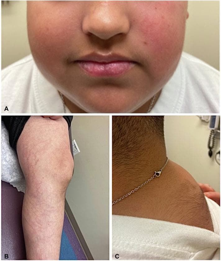 A composite of three clinical photographs demonstrating classic Cushingoid features in a pediatric patient. Panel A: Close-up of the face showing 'moon facies' characterized by rounded cheeks and noticeable facial plethora (erythema). Panel B: View of the left lower extremity showing multiple wide, slightly depressed, erythematous-to-violaceous striae (skin stretch marks) distributed across the proximal thigh and distal leg. Panel C: Lateral view of the upper back and neck region showing a prominent dorsocervical fat pad (buffalo hump) accompanied by significant hypertrichosis (increased hair growth). These visual markers are key clinical indicators of Cushing syndrome, whether endogenous or iatrogenic. The image provides educational value for medical students and clinicians in identifying dermatological and morphological manifestations of hypercortisolism.