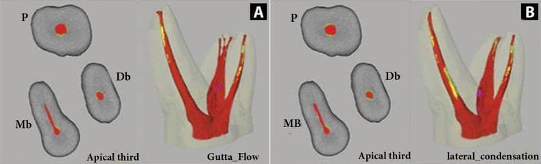 A diagnostic comparison of root canal obturation techniques using micro-computed tomography (micro-CT) imaging. The figure presents 2D cross-sections of the apical third (left) and 3D reconstructed models (right) for two methods: GuttaFlow (A) and Cold Lateral Condensation (B). The imaging employs a color-coded segmentation system to visualize canal filling quality: red represents Gutta-Percha (GP), yellow/green represents endodontic sealer, and violet indicates internal voids. In GuttaFlow (A), the GP exhibits a highly homogenous and continuous distribution throughout the canal system with minimal sealer interface and isolated micro-voids. In contrast, Cold Lateral Condensation (B) demonstrates a more heterogeneous filling pattern, characterized by larger areas of sealer (yellow/green) and a higher frequency of voids (violet) particularly along the canal walls. The 2D cross-sections (labeled P for Palatal, Db for Distobuccal, and Mb/MB for Mesiobuccal roots) further highlight the more centralized and dense GP core in the GuttaFlow group compared to the more irregular distribution in the lateral condensation group. This comparative analysis serves as an educational tool for endodontic specialists to evaluate obturation density and marginal adaptation.