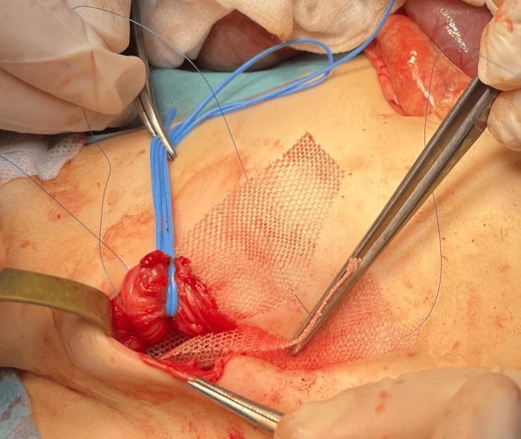 An intraoperative clinical photograph showing a step in the repair of a recurrent inguinal hernia using the Lichtenstein technique. The image features a rectangular, white, woven synthetic mesh (identified as a Vicryl patch) being positioned over the floor of the inguinal canal. A surgical forceps is visible on the right, grasping the edge of the mesh for placement. To the left, a blue vessel loop is used to retract a reddish, fleshy tissue mass, which likely represents a segment of the hernia sac or the spermatic cord. Blue non-absorbable sutures are also present within the surgical field for securing the mesh to the inguinal ligament and surrounding fascia. The surgical site is exposed via an open incision, with metal retractors maintaining visibility of the underlying anatomical structures. This visual demonstrates the tension-free mesh reinforcement used in pediatric surgery to prevent hernia recurrence, particularly in complex cases such as Loeys-Dietz syndrome.