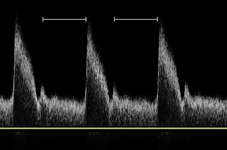 This diagnostic image displays a Doppler ultrasound spectral waveform of an arterial pulse wave, used in clinical imaging to assess hemodynamics. The waveform exhibits a characteristic triphasic or high-resistance pattern, featuring a rapid systolic upstroke (peak) followed by a sharp downstroke and a smaller secondary peak or dicrotic notch, which corresponds to the closure of the aortic valve and the onset of diastole. The base of the waveform shows low-level diastolic flow. White horizontal calipers are overlaid between the systolic peaks, specifically marking the duration of the ventricular diastole phase within the cardiac cycle. This timing is critical in shear wave elastography (SWE) for vascular assessment, as it represents the period when the arterial wall returns to its original morphology, providing a stable window (delta T) for measuring tissue stiffness and Young’s modulus in atherosclerotic plaques without the interference of the high-pressure systolic pulse.