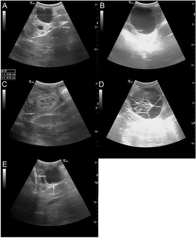 A series of five transabdominal ultrasound images (A-E) illustrating various stages and pathologies of ovarian follicular development. (A) Shows a dominant, pre-ovulatory follicle on the left ovary, measuring approximately 3.39 x 3.73 cm, displaying a characteristic hypoechoic, fluid-filled center. (B) Displays a significantly enlarged dominant follicle (approximately 60 mm) that regressed without ovulating. (C) Depicts a corpus luteum (CL) characterized by a heterogeneous, more echogenic, and solid-appearing internal texture compared to fluid-filled follicles. (D) Illustrates a large hemorrhagic anovulatory follicle (HAF) with a complex internal architecture containing multiple hyperechoic fibrous or echogenic bands and septations. (E) Shows an unstimulated atretic follicle; a white arrow highlights a distinctive ultrasound sign of atresia where the granulosa cell layer has separated or lifted from the follicle wall. These images provide diagnostic criteria for monitoring ovulation induction, distinguishing between functional luteal tissue and anovulatory structures.