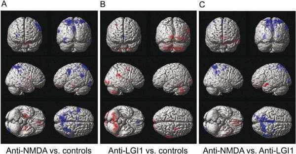 This diagnostic image set displays 18F-FDG PET data projected onto 3D brain surface reconstructions, illustrating metabolic patterns in autoimmune encephalitis. The three panels (A, B, C) show group comparisons: Panel A compares anti-NMDA receptor encephalitis to healthy controls, highlighting significant hypermetabolism (red) in frontotemporal areas and extensive hypometabolism (blue) in the parietal lobes. Panel B compares anti-LGI1 encephalitis to controls, showing hypermetabolism in the cerebellum, basal ganglia, and occipital cortex, with minimal hypometabolism in the anterior cingulate. Panel C presents a direct comparison between the two conditions, identifying distinct metabolic signatures used for differential diagnosis. The rows show different views (superior, lateral, and inferior) to provide a comprehensive cortical map. These PET patterns demonstrate that anti-NMDA receptor encephalitis typically presents with a frontotemporal-to-parietooccipital gradient of glucose metabolism, whereas anti-LGI1 is characterized by subcortical and cerebellar hypermetabolism.