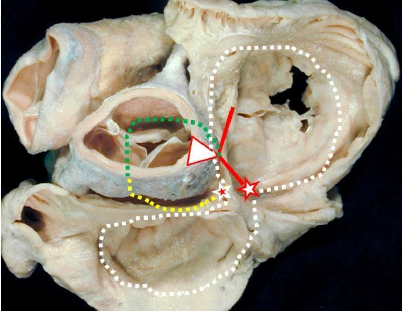 Anatomical Diagram over a clinical photograph of a gross cardiac specimen, viewed from the atrial aspect (superior view) of the cardiac base. The image illustrates the complex anatomy of the cardiac conduction system and vestigial embryonic structures. Key landmarks include the atrioventricular (AV) node (white star with red borders) and the retroaortic node (red star with white borders). The conduction pathway is delineated by a solid red line representing the bundle of His. Supplemental embryonic and auxiliary tracts are marked with dotted lines: a green dotted line shows the 'dead-end tract' continuing from the AV conduction axis toward the outflow tract; a yellow dotted line marks the retro-aortic ring branch; and a white dotted line traces the path of the embryonic atrioventricular ring. This visual is designed for advanced medical education in cardiac electrophysiology and embryology, highlighting the anatomical basis for idiopathic ventricular arrhythmias and the clinical significance of persistent embryonic tissues within the heart's conduction framework.