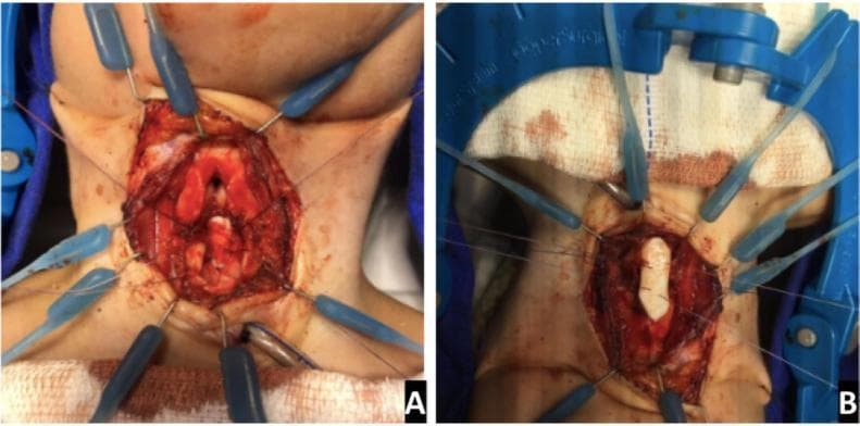 Two clinical photographs (A and B) showing an intraoperative view of a Laryngotracheal Reconstruction (LTR) for subglottic stenosis. The surgical field is exposed via a midline neck incision, with skin and subcutaneous tissues held open by a Lone Star retractor system with multiple blue elastic stays. Image A demonstrates the posterior expansion of the cricoid cartilage; a vertical incision is visible through the posterior cricoid lamina to enlarge the airway diameter. Image B shows the anterior expansion phase, where a white, rectangular costal cartilage graft (rib graft) has been carved and securely placed into the anterior cricoid split to provide structural support and widen the lumen. The surgical site displays anatomical landmarks of the larynx and upper trachea. This visual illustrates the surgical management of complex airway narrowing through both posterior and anterior grafting techniques, a common procedure in pediatric otolaryngology.