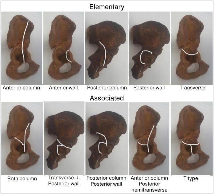 Educational diagram illustrating the Judet-Letournel classification of acetabular fractures using anatomical specimens of the hemipelvis. The visual is divided into two rows: 'Elementary' and 'Associated' fracture types. White lines superimposed on the specimens delineate specific fracture patterns. The 'Elementary' row features five simple patterns: Anterior column (vertical line through the pelvic brim), Anterior wall (localized articular segment), Posterior column (ischiadic notch through obturator foramen), Posterior wall (localized posterior rim), and Transverse (horizontal line bisecting the acetabulum). The 'Associated' row demonstrates complex configurations: Both column, Transverse plus posterior wall, Posterior column plus posterior wall, Anterior column with posterior hemitransverse (a vertical anterior column line joined by a horizontal posterior component), and T-type (a transverse fracture with an additional vertical stem extending through the obturator foramen). This orthopedic diagram serves as a clinical reference for orthopedic surgeons and medical students to understand pelvic trauma morphology and surgical planning.