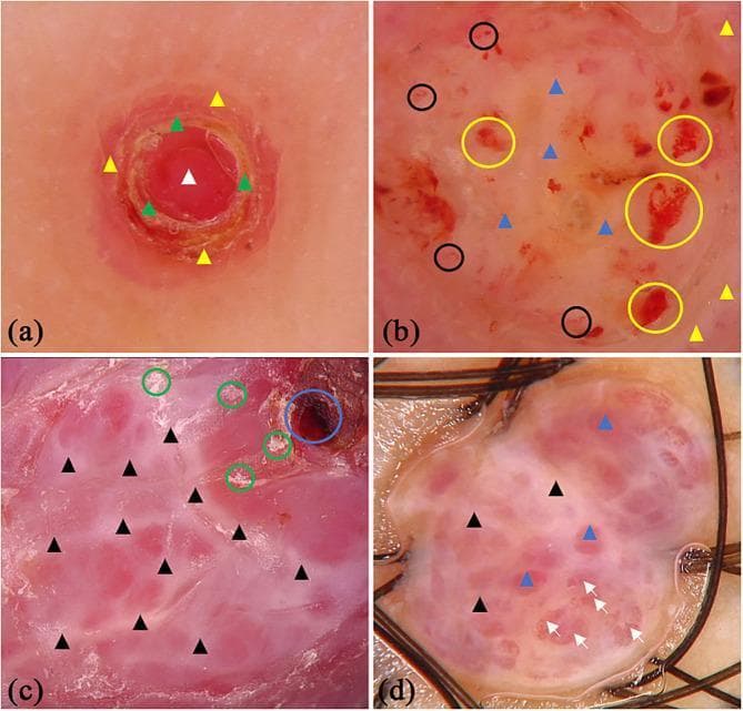 Dermoscopic images of pyogenic granuloma (PG) presented in a four-panel figure (a-d) demonstrating characteristic vascular and architectural features. Panel (a) shows a central red homogeneous area with surrounding yellow scabs and a peripheral white collar pattern. Panel (b) reveals a mixed red-white homogeneous background with distinct vascular structures (black circles), areas of hemorrhage (yellow circles), and a white collarette. Panel (c) highlights 'white rail' lines—whitish streaks intersecting the lesion—along with dark red scabs and superficial white scales. Panel (d) demonstrates a red-white background with prominent 'white rail' lines and serpentine (serpiginous) vessels marked by white arrows. These clinical photographs illustrate the diagnostic dermoscopic criteria for PG, including the white collarette, homogeneous red/white areas, and specific vascular morphologies like serpentine vessels, which are critical for differentiating PG from other vascular or melanocytic skin lesions in dermatology.