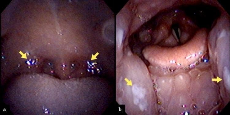 Two endoscopic images (a and b) documenting the clinical presentation of the pharynx and larynx in a patient with suspected infectious mononucleosis. Image (a) is an oropharyngeal view showing bilateral, grade II Mackenzie classification tonsillar swelling. There is notable erythema of the soft palate and localized yellow-white exudate (pus) on the tonsillar surfaces (indicated by yellow arrows), without confluent pseudomembranes. Image (b) provides a laryngeal endoscopic view looking down toward the glottis. It reveals significant edema and swelling of the lingual tonsils and posterior third of the tongue (yellow arrows). Anatomical landmarks including the epiglottis and vocal folds are visible; notably, there is an absence of laryngeal or epiglottic edema that would suggest airway compromise. These visual findings are characteristic of viral pharyngotonsillitis, often seen in Epstein-Barr virus (EBV) infections, and are used to differentiate from bacterial streptococcal pharyngitis or more severe supraglottic infections.