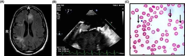 A composite clinical image consisting of three panels illustrating a multi-organ manifestation of Thrombotic Thrombocytopenic Purpura (TTP). Panel A is an axial T2 FLAIR magnetic resonance image of the brain showing hyperintense signals in the left anterior cerebral artery (ACA) distribution, consistent with acute infarction, alongside chronic hypointense areas indicating prior infarcts. Panel B displays a two-dimensional trans-esophageal echocardiogram (TEE) focused on a prosthetic mitral valve; it reveals a 1.5 cm irregular, echogenic mass (vegetation) attached to the atrial surface, indicative of non-bacterial thrombotic endocarditis. Panel C shows a Wright-Giemsa stained peripheral blood smear at high power. The smear demonstrates microangiopathic hemolytic anemia characterized by prominent schistocytes (fragmented red blood cells), indicated by black arrows, against a background of normocytic erythrocytes. Together, these images teach the classic clinical triad of neurological deficits, cardiac involvement, and hematologic evidence of microangiopathy associated with ADAMTS13 deficiency.