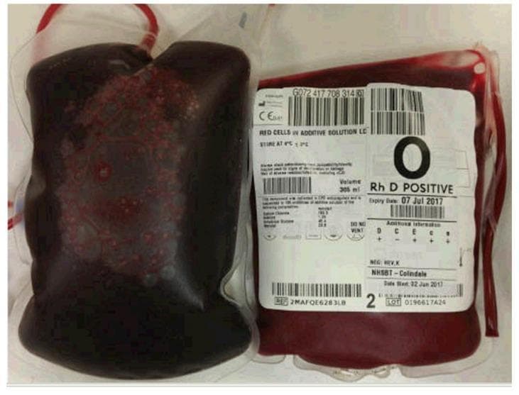 Clinical photograph showing a side-by-side comparison of two blood bags, illustrating a striking color discrepancy indicative of specific hemoglobinopathies. On the left is a bag of venesected patient blood characterized by a dark, 'chocolate brown' or muddy hue, which is a classic diagnostic sign of sulfhemoglobinemia or methemoglobinemia. Unlike normal deoxyhemoglobin, this discoloration does not revert to bright red upon exposure to oxygen. Small, dark red aggregations are visible within the brownish fluid. On the right is a standard donor unit of 'RED CELLS IN ADDITIVE SOLUTION' for comparison, exhibiting the expected bright red color of healthy, oxygenated blood. The donor bag label identifies it as Type O Rh D Positive. This image serves as a visual teaching tool for hematology and emergency medicine, demonstrating the clinical presentation of 'chocolate-colored blood' which often correlates with central cyanosis and low pulse oximetry readings despite normal arterial oxygen tension (PaO2).
