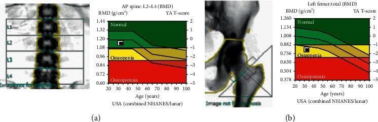 Dual-energy X-ray absorptiometry (DXA) report illustrating bone mineral density (BMD) assessments for the lumbar spine and left femur. Figure (a) displays an AP spine scan of vertebrae L1-L4 alongside a BMD graph for L2-L4. The graph plots BMD (g/cm²) and Young Adult (YA) T-score against age (20-100 years), categorized into WHO-defined zones: Normal (green, T-score > -1.0), Osteopenia (yellow, T-score between -1.0 and -2.5), and Osteoporosis (red, T-score < -2.5). The patient's data point (1.140 g/cm², Z-score -0.4) is located within the normal zone. Figure (b) shows the DXA scan of the left hip/femur with a corresponding graph for the total femur. The patient's measurement (0.807 g/cm², Z-score -1.4) is plotted within the yellow osteopenia zone. These visuals serve as diagnostic tools for evaluating skeletal health and fracture risk in the context of metabolic bone diseases like Hereditary Hypophosphatemic Rickets with Hypercalciuria (HHRH).
