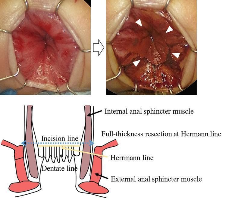 This composite educational resource comprises clinical photographs and a labeled anatomical diagram illustrating the use of Lugol's iodine staining during ileal pouch-anal canal anastomosis (IPACA). The top-left clinical photograph shows the anal canal pre-staining with an anal retractor in place. The top-right photograph demonstrates the 'after' effect following the application of 1% Lugol’s iodine; white arrowheads indicate Herrmann's line, where iodine-positive squamous epithelium stains a dark brown/red color, creating a distinct visual demarcation from the non-staining columnar mucosa. The bottom anatomical diagram provides a coronal cross-section of the anal canal, labeling the internal and external anal sphincter muscles. It identifies the dentate line and Herrmann's line (the upper margin of the surgical anal canal), indicating the specific incision line for full-thickness resection. This visual aid is designed for surgical education in pediatric surgery or gastroenterology, specifically highlighting the technique to accurately identify surgical margins to preserve anal sensation and ensure complete aganglionic tissue removal.
