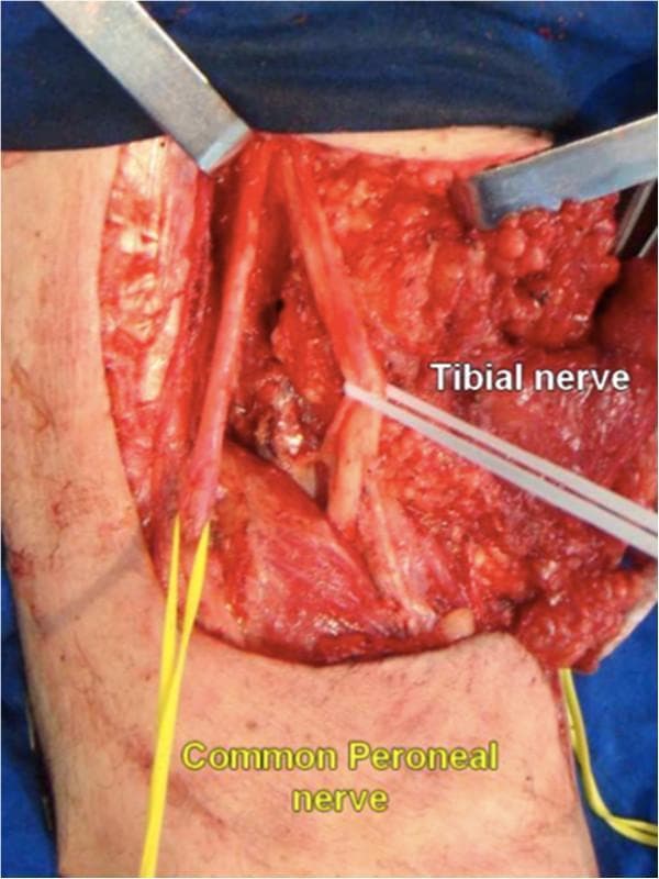 This clinical surgical photograph demonstrates the intraoperative anatomy of the popliteal fossa, specifically focusing on the bifurcation of the sciatic nerve. The surgical field is exposed using metal retractors to retract skin flaps and adipose tissue, revealing the underlying muscular and neurovascular structures. Centrally, the sciatic nerve is seen dividing into two major terminal branches: the tibial nerve and the common peroneal (common fibular) nerve. The tibial nerve is labeled and appears as a larger, more medial vertical branch. The common peroneal nerve is also labeled, branching laterally toward the fibular head. Both nerves are isolated and gently manipulated using colored vessel loops (yellow and white) to provide traction and facilitate clear visualization of the nerve courses and surrounding muscle groups, including the gastrocnemius heads and the biceps femoris. This image serves as an educational resource for identifying peripheral nerve anatomy during posterior approach leg surgeries and popliteal space dissections.