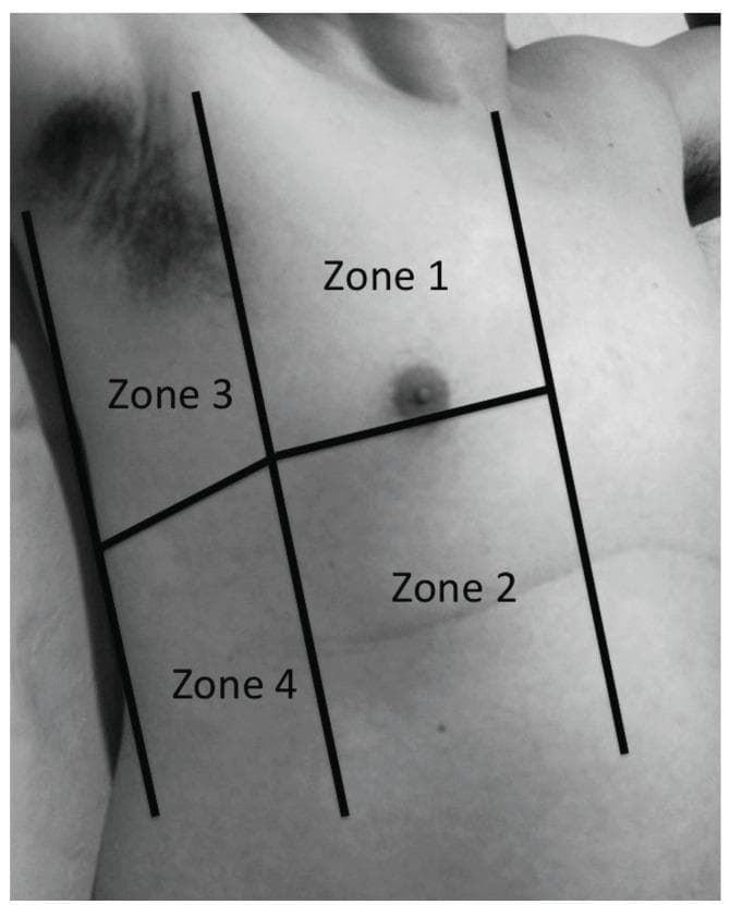 A clinical photograph in grayscale illustrating the surface anatomy and mapping of the right thoracic wall. The chest is partitioned into four distinct quadrants or 'zones' using superimposed anatomical reference lines. Three vertical lines represent the parasternal, anterior axillary, and posterior axillary lines, while a single horizontal line bisects these vertically to create upper and lower halves. The resulting regions are labeled: Zone 1 (upper anterior), Zone 2 (lower anterior), Zone 3 (upper lateral), and Zone 4 (lower lateral). This anatomical diagram is intended for clinical training, specifically for standardizing the physical examination of skin lesions or documenting findings during point-of-care ultrasound (POCUS) protocols. The image provides a clear reference for medical students and clinicians to accurately localize pathology relative to thoracic landmarks.