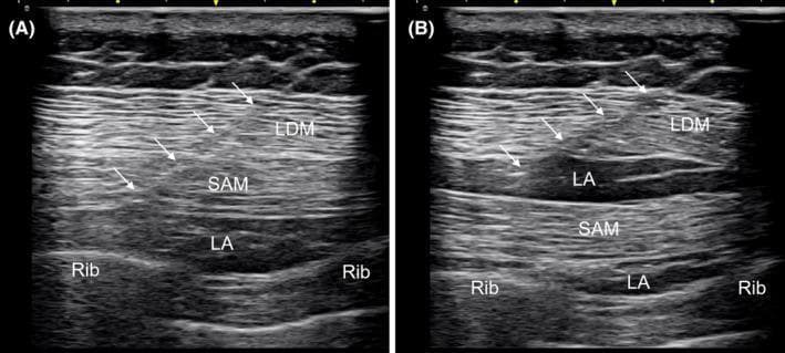 Diagnostic ultrasound images illustrating a serratus plane block (SPB) for regional anesthesia. The visuals demonstrate the layered musculoskeletal anatomy of the lateral chest wall. In both panels, the latissimus dorsi muscle (LDM) is the most superficial muscle layer, followed by the deeper serratus anterior muscle (SAM), which lies directly above the ribs. The ribs are identified by their characteristic curved hyperechoic margins with posterior acoustic shadowing. Image A shows a deep serratus plane block, where the local anesthetic (LA)—visible as an anechoic/hypoechoic fluid collection—is injected between the SAM and the underlying rib. Image B illustrates a dual-plane or superficial block, showing LA distribution both superficial to the SAM (between the LDM and SAM) and deep to the SAM. A Tuohy needle (indicated by white arrows) is visible using the in-plane technique, tracking through the muscle layers to the target fascia. This content is used to teach ultrasound-guided regional anesthesia techniques for pain management in thoracic and chest wall surgeries.