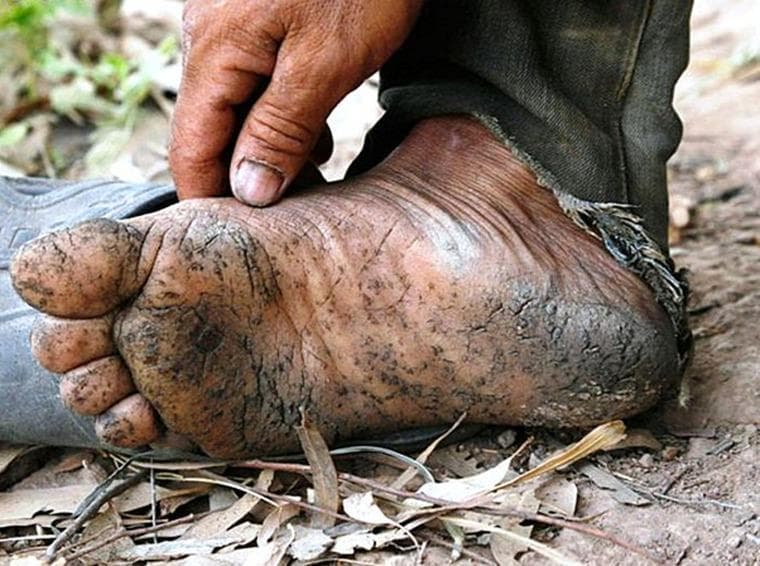 This clinical photograph displays characteristic cutaneous manifestations of chronic arsenicosis, specifically palmoplantar hyperkeratosis and dyspigmentation, on the foot of an individual. The plantar surface exhibits diffuse skin thickening (hyperkeratosis) with a rough, fissured, and cracked texture. Prominent hyperpigmented macules and patches are distributed across the sole, often described as a 'raindrops on a dusty road' pattern. The skin appears weathered and xerotic, with visible debris embedded in the epidermal cracks. Educational focus is placed on the recognition of chronic heavy metal toxicity signs, which often include these specific keratotic lesions and pigmentary changes. The surrounding context, including worn clothing and weathered skin on the hand, suggests prolonged environmental or occupational exposure to arsenic, typically through contaminated groundwater or industrial processes. This image serves as a diagnostic reference for dermatological signs of systemic arsenic poisoning.