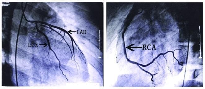 Two diagnostic images showing coronary angiography findings in a patient with suspected myocardial ischemia. The left panel displays the left coronary system, with labels identifying the Left Anterior Descending (LAD) artery and the Left Circumflex (LCX) artery. The LAD is seen descending toward the cardiac apex with visible diagonal branches, while the LCX courses posteriorly along the atrioventricular groove with visible marginal branches. The right panel displays the Right Coronary Artery (RCA) in a C-shaped configuration, showing its descent along the right side of the heart and its posterior interventricular branches. Both panels demonstrate smooth vessel contours, normal physiological tapering, and unobstructed contrast flow through the epicardial coronary arteries. There are no signs of significant stenosis, occlusion, or coronary artery disease, which helps differentiate myocarditis from acute myocardial infarction in a clinical setting.