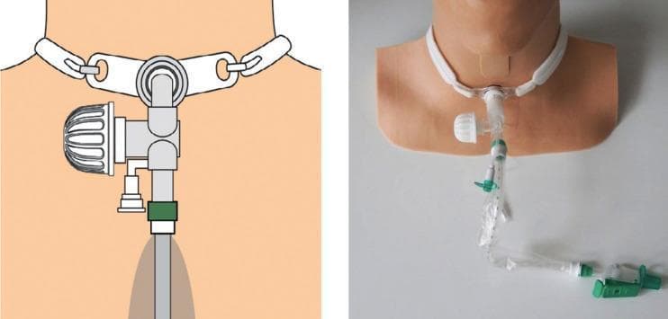 This composite image consists of a technical illustration (left) and a corresponding clinical photograph of a medical manikin (right) demonstrating the Kelley Circuit, a specialized respiratory assembly for tracheostomized patients. The assembly is secured to the neck via a standard tracheostomy tube and neck strap. Key components include a ProTrach XtraCare heat and moisture exchanger (HME) featuring an integrated electrostatic filter, which is attached to the lateral ventilator hub. Connected directly to the ISO 15 hub of the tracheostomy tube is a closed-circuit suction system, visible as a clear, flexible tube partially enclosed in a transparent protective plastic sleeve with green mechanical valves and connectors. This configuration is designed to provide viral and bacterial filtration while allowing for airway clearance without disconnecting the patient from the circuit, thereby reducing the risk of aerosolization and tube drag. It is clinically relevant for critical care and respiratory therapy education, specifically regarding the management of spontaneously breathing patients requiring humidification and frequent suctioning.