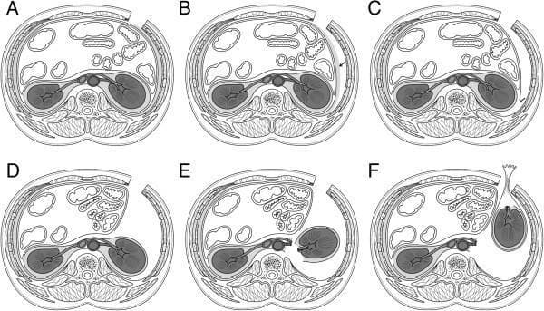 This medical diagram consists of six axial schematic frames (A–F) illustrating the surgical progression of a Gasless Radical Nephrectomy via Reduced Port Surgery (RASI) in the supine position. Frame A shows the baseline anatomy with a subcostal skin incision. Frame B depicts the excision of fatty tissue on the lateroconal fascia (LCF). Frame C demonstrates the longitudinal incision of the LCF to expose Gerota’s fascia. Frame D illustrates the medial retraction of the peritoneum to gain access to the retroperitoneal space. Frame E shows the dissection of the renal hilum, including the renal artery and vein, and the mobilization of the kidney from its attachments. Finally, frame F displays the extraction of the renal specimen through the surgical site using a specialized retrieval device. Key anatomical structures visible throughout the series include the abdominal wall muscles (external oblique, internal oblique, and transversus abdominis), the aorta, inferior vena cava, kidneys, and surrounding peritoneal contents. This educational graphic focuses on the surgical pathway and tissue layers involved in retroperitoneal urologic procedures.