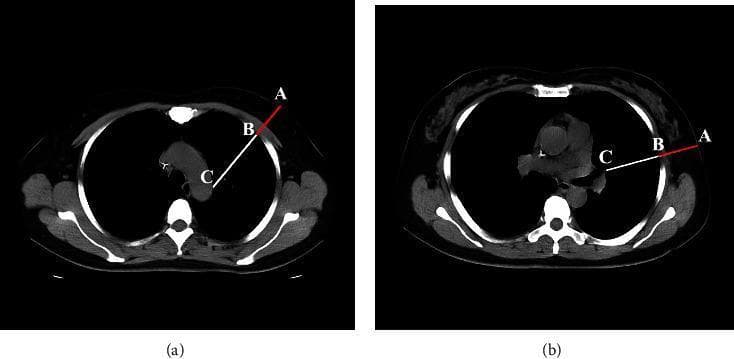This diagnostic image consists of two axial non-contrast chest CT slices (a and b) demonstrating anatomical measurements relevant to needle thoracentesis safety. Figure (a) shows a cross-section at the level of the right second intercostal space midclavicular line (ICS-MCL), while figure (b) shows the level of the fifth intercostal space mid-axillary line (ICS-MAL). Both images feature labeled points A, B, and C with corresponding measurement vectors. Point A is located on the external skin surface, Point B is at the parietal pleura, and Point C marks the border of a vital mediastinal structure (such as the aorta or pulmonary vessel). The red segment AB represents the Chest Wall Thickness (CWT), indicating the radial depth from the skin to the pleural space. The white line segment AC represents the 'smallest depth to vital structure' (DVSclose), which measures the minimum distance from the skin surface to intrapleural vital organs. These images illustrate the clinical significance of needle length selection to avoid iatrogenic injury to cardiac or vascular structures during thoracic decompression procedures.