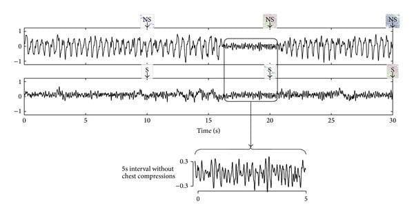 This comparative ECG waveform diagram illustrates the efficacy of adaptive filtering in suppressing cardiopulmonary resuscitation (CPR) artifacts during out-of-hospital cardiac arrest (OHCA). The top panel displays a 30-second electrocardiogram strip corrupted by high-amplitude, rhythmic oscillations caused by chest compressions. These artifacts obscure the underlying cardiac rhythm, leading a Shock Advisory Algorithm (SAA) to produce incorrect 'No-Shock' (NS) diagnoses. The bottom panel shows the same ECG segment after processing with an adaptive filter; the large-scale artifacts are significantly attenuated, revealing the underlying low-amplitude, disorganized activity characteristic of Ventricular Fibrillation (VF). An inset focus area highlights a 5-second interval where chest compressions were paused, providing visual confirmation that the filtered signal accurately represents the underlying VF. Following filtration, the SAA correctly identifies the rhythm as shockable ('S'). This graphic demonstrates the clinical importance of advanced signal processing in automated external defibrillators (AEDs) to maintain diagnostic accuracy during active resuscitation.