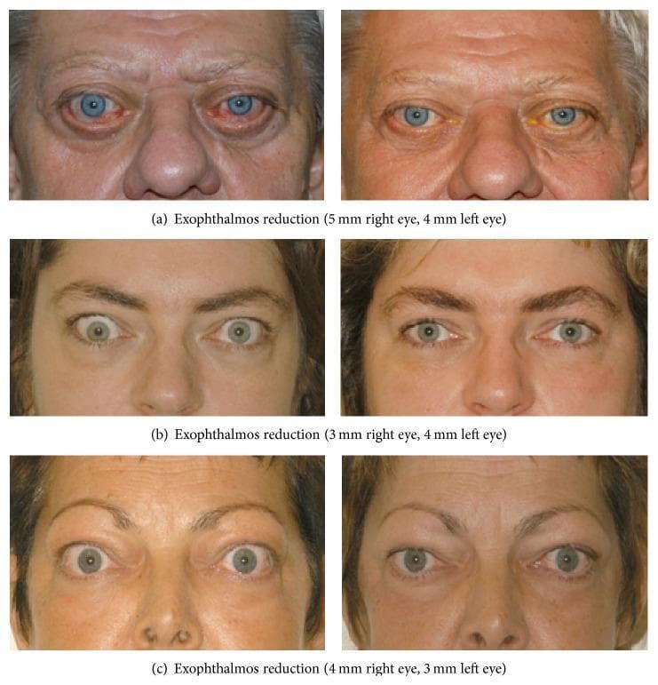 This clinical comparison chart presents three sets (a, b, c) of pre- and post-operative facial photographs documenting the results of bilateral orbital decompression in patients with Graves' ophthalmopathy (thyroid eye disease). The 'before' images on the left consistently demonstrate significant proptosis (exophthalmos), characterized by ocular prominence, upper eyelid retraction, and excessive scleral show both superiorly and inferiorly. In case (a), there is also visible conjunctival injection and chemosis. The 'after' images on the right, taken 6 months to 2 years post-surgery, show a marked reduction in globe protrusion (measured between 3–5 mm reduction per eye). Key visual improvements include a normalized eyelid position with reduced retraction, decreased scleral exposure, and a more relaxed periocular skin appearance. These images illustrate the surgical management of Graves' ophthalmopathy to reduce orbital volume, protecting the ocular surface and improving aesthetic outcomes by resolving the 'staring' expression associated with the disease.