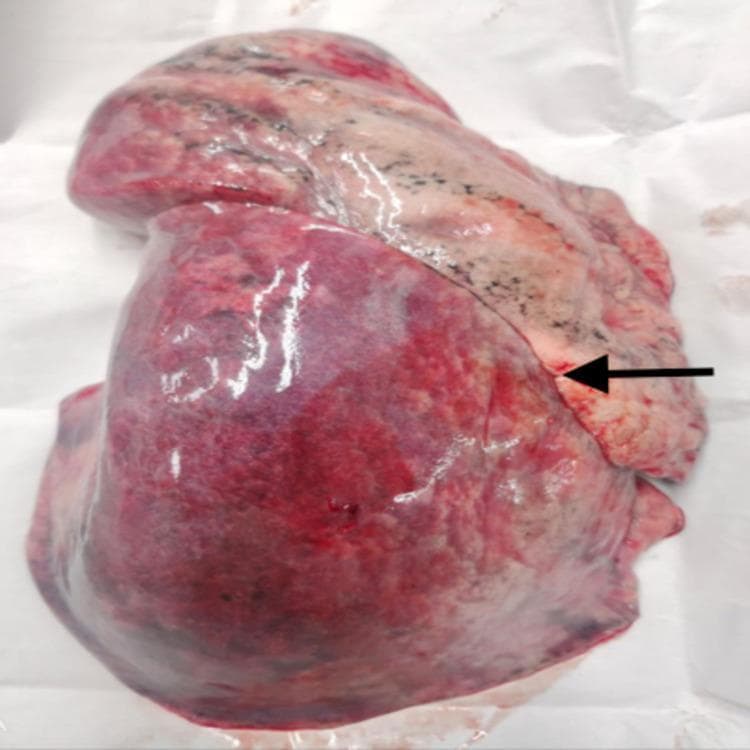 This clinical photograph displays a gross anatomical specimen of a human left lung, focusing on the lobar morphology and pleural surface. The primary feature is a well-defined, complete oblique fissure, marked by a black arrow, which extends across the lateral surface to anatomically separate the superior (upper) and inferior (lower) lobes. The lung parenchyma exhibits a mottled appearance with varied coloration: the upper lobe shows lighter pinkish tones interspersed with dark, anthracotic pigment spots typical of carbon particle deposition. In contrast, the lower lobe presents a deeper reddish-purple hue, likely indicating post-mortem congestion or hypostatic changes. The visceral pleura appears smooth and glistening. Small hexagonal outlines of pulmonary lobules are visible on the surface. This specimen serves as an educational reference for normal thoracic anatomy and common anatomical variations in pulmonary fissures, which are clinically significant for surgical resection, bronchoscopic interventions, and the localization of pulmonary pathology.