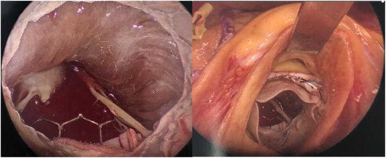 This composite of two intraoperative clinical photographs illustrates the surgical implantation of Edwards Sapien 3 transcatheter valves in both mitral and aortic positions. The left image provides a subvalvular view from the left ventricle, demonstrating a 29 mm Sapien 3 valve deployed in the native mitral annulus (SITRAL technique). The valve's characteristic cobalt-chromium hexagonal frame is visible through cardiac tissue, with a yellow surgical probe positioned nearby. The right image shows an intraoperative view through an aortotomy, revealing a second Sapien 3 valve secured in the aortic position. The aortic walls are retracted, showing the valve leaflets and the surrounding tissue of the aortic root. These images demonstrate a complex double-valve replacement strategy utilized in a patient with severe mitral annular calcification (MAC) and aortic stenosis. The educational focus is on the direct surgical placement of balloon-expandable transcatheter heart valves (THVs) during open-heart surgery as an alternative to conventional valve replacement in high-risk anatomical scenarios.