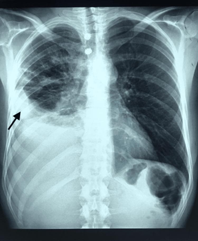 A posterior-anterior (PA) view frontal chest radiograph (X-ray) demonstrating a large unilateral right-sided pleural effusion. The key finding, highlighted by a black arrow, is a dense, homogeneous opacity occupying the lower half of the right hemithorax. This opacity features a characteristic 'meniscus sign,' where the superior border is higher laterally and curves downwards toward the mediastinum. The finding results in complete blunting or obliteration of the right costophrenic angle and obscuration of the right hemidiaphragm silhouette. In contrast, the left lung field is clear with a sharp costophrenic angle and a visible diaphragmatic contour. The mediastinal silhouette and trachea appear centrally positioned without significant deviation. Multiple radiopaque circular artifacts, consistent with ECG monitoring electrodes, are visible overlying the upper thoracic region. This imaging is diagnostic for pleural fluid accumulation, providing an educational example of how large effusions mask normal pulmonary anatomy.