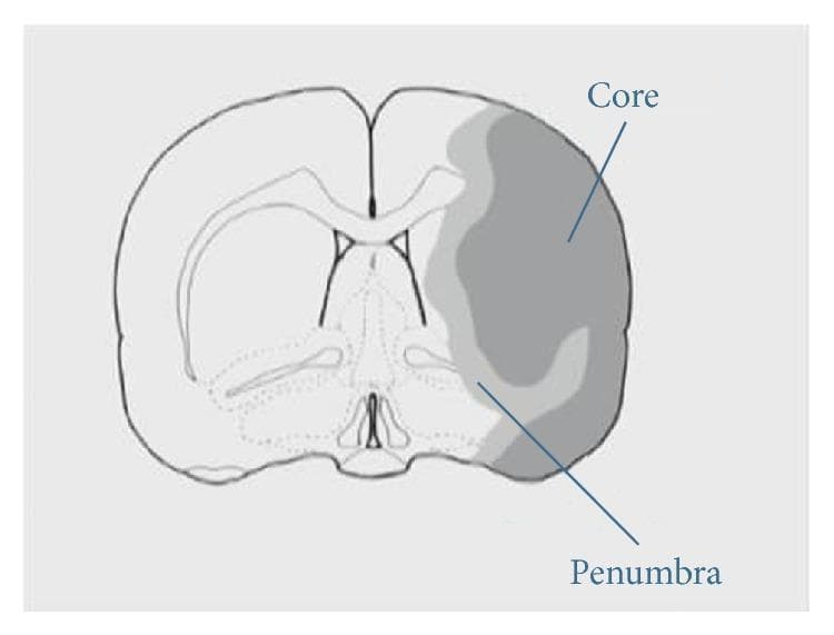 This medical schematic diagram illustrates a coronal brain section, commonly used in preclinical stroke research to represent ischemic injury. The diagram shows the bilateral hemispheres with visible internal structures including the corpus callosum, ventricles, and striatum. In the right hemisphere, a distinct pathological region is highlighted to demonstrate the spatial organization of an acute ischemic stroke. A central, darkly shaded area is labeled 'Core,' representing the ischemic core where irreversible tissue infarction typically occurs due to severe blood flow deprivation. Surrounding this central lesion is a lighter shaded region labeled 'Penumbra.' This ischemic penumbra represents the peri-infarct zone—salvageable brain tissue that is functionally impaired but metabolically viable. The diagram serves as an educational tool for neurology and neurosurgery to visualize the therapeutic window in stroke management, where the primary clinical objective is to restore perfusion to the penumbra to prevent its recruitment into the infarct core.