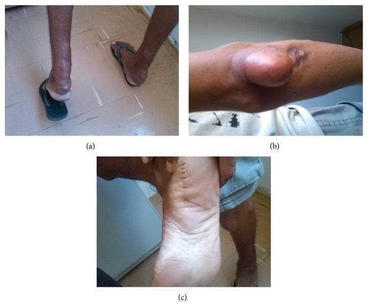 This composite of three clinical photographs displays classic dermatological manifestations of Familial Hypercholesterolemia (FH). Panel (a) shows bilateral Achilles tendon xanthomas, presenting as large, firm, rounded subcutaneous swellings at the posterior aspect of the heels that significantly distort the local anatomy. Panel (b) illustrates a tuberous xanthoma on the elbow, characterized by a large, well-circumscribed, flesh-colored to slightly yellowish nodular protrusion with a smooth overlying surface. Panel (c) shows the plantar aspect of the foot, demonstrating planar xanthomas that cause diffuse thickening and yellowish discoloration of the sole, along with a visible vertical surgical incision line with sutures. These findings are highly characteristic of severe hyperlipidemia, specifically FH, where lipid deposits accumulate in the skin and tendons. The images serve as an educational reference for identifying physical stigmata of lipid metabolism disorders in a clinical setting.