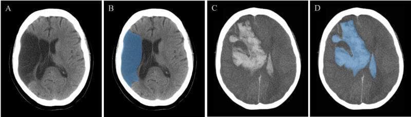 Hugging Face pmc clinical VQA raw