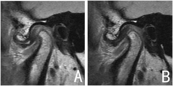 This diagnostic image displays side-by-side parasagittal MRI scans of the human temporomandibular joint (TMJ), categorized as a comparison of treatment outcomes for internal derangement. Panel A demonstrates Disc Displacement with Reduction (DDwR) before treatment; the articular disc is positioned anteriorly relative to the mandibular condyle, with a noticeable increase in the posterior joint space. Panel B shows the same joint after functional appliance therapy, illustrating successful disc recapture. In this post-treatment view, the intermediate zone of the biconcave disc is correctly interposed between the superior aspect of the condyle and the posterior slope of the articular eminence. Notably, the condylar morphology remains stable between both images, showing no evidence of degenerative changes or significant osseous remodeling. This comparison serves as an educational example of a 'good outcome' in orthodontic or maxillofacial management of TMJ disorders, highlighting the restoration of anatomical disc-condyle relationships.