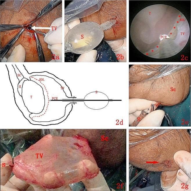 A multi-panel figure illustrating the 'Su-Wang technique' for treating hydrocele via endoscopic resection of the tunica vaginalis (TV). Panel (a) shows a 1 cm transverse incision on the anterior-superior scrotum exposing the parietal TV. (b) Demonstrates the insertion of a specialized working sheath (S) into the vaginal cavity. (c) Provides an endoscopic view where a plasma cylindrical electrode (PCE) is used to create a circular marker (red dotted line, RDL) on the parietal TV, approximately 1–2 cm away from the testis (T). (d) Is a schematic diagram showing the spatial relationship between the sheath, electrode, testis, epididymis (E), and spermatic cord (SC). Panels (e) and (f) depict the blunt separation and complete stripping of the parietal TV from the scrotal wall (Sc) using the sheath for traction. (g) Shows the final 1 cm surgical site immediately after the procedure. This clinical photograph and diagram set demonstrates a minimally invasive urological technique for hydrocele sac resection.