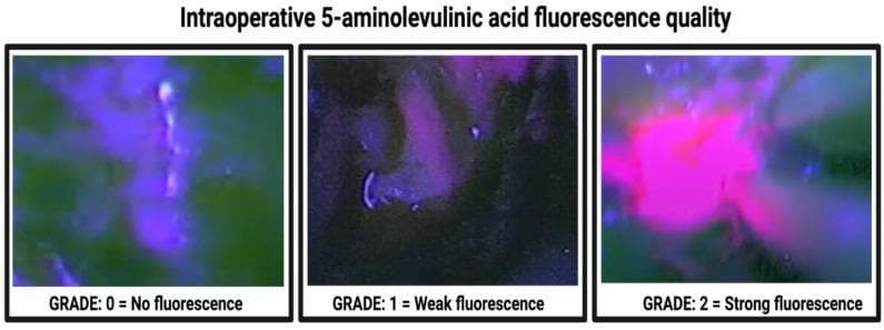 This diagnostic comparison chart illustrates the 3-stage classification system for intraoperative 5-aminolevulinic acid (5-ALA) fluorescence quality grading in neurosurgery, specifically for identifying high-grade glioma margins. The image comprises three side-by-side panels captured under 400 nm violet-blue excitation light.
- Grade 0 (No fluorescence): Shows a predominantly green/dark background with minimal Protoporphyrin IX accumulation; no distinct pink or purple emission is visible.
- Grade 1 (Weak fluorescence): Displays a subdued, localized purple/pink hue against a dark background, indicating low-level fluorescence that remains transparent enough to see underlying tissue texture.
- Grade 2 (Strong fluorescence): Exhibits intense, vibrant lava-pink or solid purple fluorescence that is opaque and clearly demarcated from surrounding non-fluorescent tissue.
This scale is a standard neurosurgical tool used during fluorescence-guided resection (FGR) to differentiate tumor tissue from healthy brain parenchyma, aiding in achieving gross total resection of glioblastomas.