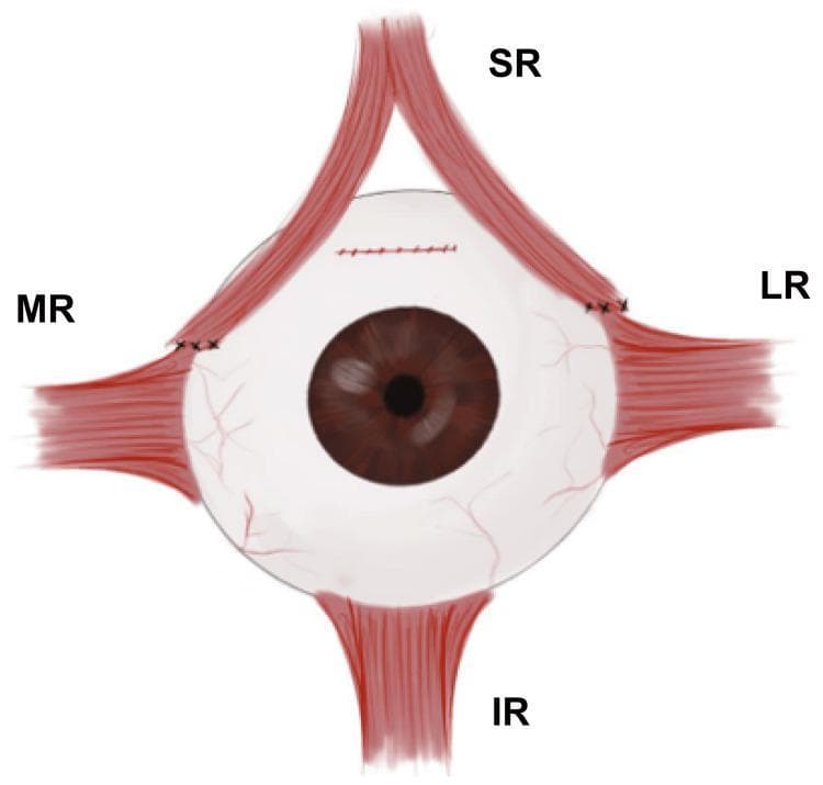 This medical illustration depicts a surgical procedure on the extraocular muscles of the left eye, identified as the Sesma-AlGhazal procedure. The anatomical diagram shows the eyeball with four rectus muscles: Superior Rectus (SR), Medial Rectus (MR), Lateral Rectus (LR), and Inferior Rectus (IR). The SR muscle is demonstrated as longitudinally split into two distinct halves. The medial half of the SR has been transposed and sutured anterior to the original insertion of the MR. Simultaneously, the lateral half of the SR has been transposed and sutured superior to the insertion point of the LR. Black surgical sutures are visible at both new insertion points and at the original superior scleral site where the SR was detached. This muscle transpositioning technique is used in ophthalmology to correct specific forms of strabismus, such as hypotropia, by redistributing the mechanical forces of the SR to assist adjacent muscles. The diagram serves as an educational tool for ophthalmologists and medical students to understand ocular motility surgery and muscle transposition geometry.