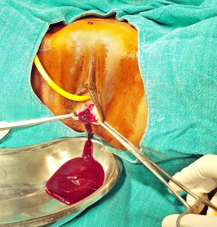 Clinical photograph of a surgical procedure illustrating the drainage of hematocolpos in a patient with an imperforate hymen. The patient is in the lithotomy position, with the perineal region prepped and draped using green surgical cloths. A cruciate incision has been made at the hymen, and two surgical forceps are seen retracting the edges to maintain patency. A large volume of dark red, viscous, ‘chocolate-like’ blood (retained menstrual fluid) is actively draining into a stainless steel kidney tray positioned below the introitus. A yellow Foley catheter is visible in the urethra to prevent urinary retention and clearly demarcate the urethral anatomy during the procedure. This visual demonstrates the surgical management of hematocolpometra and the typical appearance of stagnant menstrual blood. The image is relevant for gynecology and obstetrics, specifically in the context of adolescent health and congenital Müllerian anomalies.