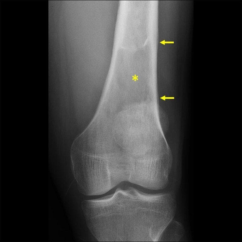 This diagnostic x-ray shows an anteroposterior (AP) view of the distal femur and knee joint, demonstrating a primary bone pathology. A prominent intramedullary lytic lesion is visible in the distal femoral shaft (indicated by a yellow asterisk), characterized by an area of decreased bone density and loss of normal trabecular pattern. Along the lateral aspect of the femoral diaphysis, there is a distinct lamellated (onion-skin) periosteal reaction, marked by yellow arrows. This aggressive periosteal pattern suggests a rapidly progressing process. Despite the intramedullary involvement and periosteal lifting, the cortical integrity appears largely preserved without gross pathological fracture. This radiographic presentation is clinically significant in the study of musculoskeletal oncology, commonly associated with conditions such as Ewing sarcoma or osteomyelitis. The image serves as an educational resource for identifying aggressive bone lesions, distinguishing between different patterns of periosteal reaction, and understanding the radiological evaluation of pediatric or adolescent bone tumors.
