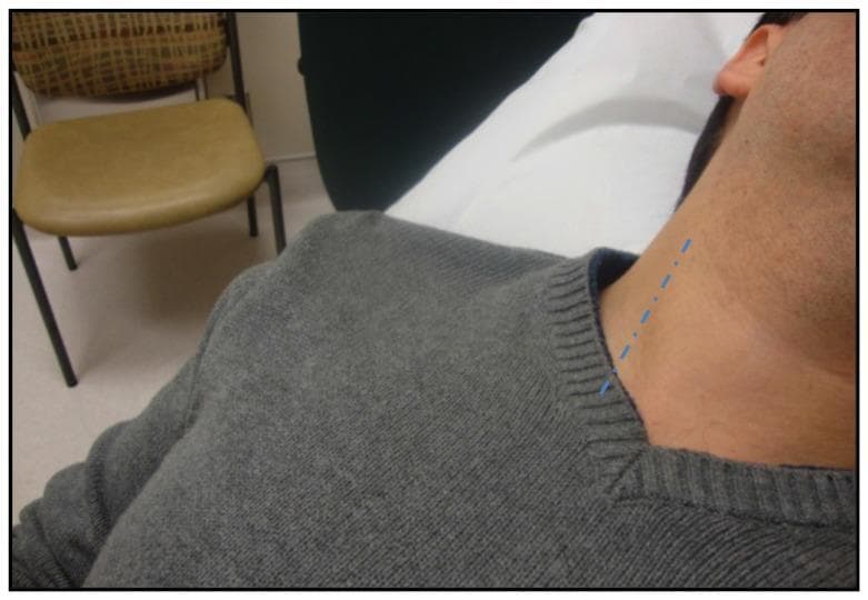 This clinical photograph demonstrates the positioning for a bedside assessment of Jugular Venous Pressure (JVP). The patient is shown in a semi-recumbent position, with the head of the bed typically elevated to approximately 30–45 degrees to allow for optimal visualization of the venous pulsations. The patient's head is slightly rotated to the left to expose the right side of the neck. A blue dotted line is superimposed on the skin to indicate the anatomical course of the internal jugular vein (IJV), which typically runs deep to the sternocleidomastoid muscle between its sternal and clavicular heads. The image illustrates a key step in physical examination for estimating central venous pressure (CVP) and assessing volume status in cardiovascular and internal medicine. The educational focus is on identifying the surface anatomy relevant to the IJV and the standardized patient positioning required to measure the vertical distance of the venous column above the sternal angle of Louis.