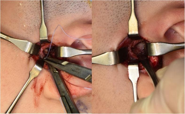 This clinical photograph shows an intraoperative view of a temporomandibular joint (TMJ) disc plication procedure. The surgical field is established via a preauricular approach, with four metallic Senn-Miller retractors providing exposure of the joint space. In the left panel, a pair of needle holders is shown manipulating a fine, light-colored No. 2-0 braided polyester suture. This suture is used to secure the posterior segment of the TMJ disc to a MITEK mini anchor (not directly visible) previously implanted on the lateral, superior, and posterior aspect of the mandibular condyle. The right panel displays the exposed anatomical structures of the TMJ, including the articular disc and the condylar head, following surgical liberation from adhesions. The tissue appears hyperemic with minor surgical hemorrhaging, characteristic of active dissection within the joint capsule. This visual demonstrates a critical step in surgical repositioning for internal derangement of the TMJ, focusing on stabilizing the disc-condyle relationship through suture-to-bone anchoring.
