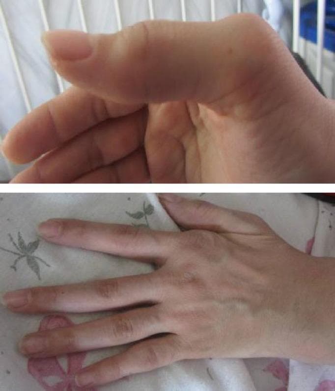 Clinical photographs of a hand demonstrating chronic structural deformities characteristic of rheumatoid arthritis. The upper image provides a lateral view focusing on a digit showing a prominent deformity at the proximal interphalangeal (PIP) joint and enlargement of the metacarpophalangeal (MCP) joint. The lower image provides a dorsal view of the hand, illustrating significant ulnar deviation of the fingers at the MCP joints, which is a classic hallmark of progressive inflammatory arthritis. There is visible soft tissue swelling and joint enlargement at the 2nd metacarpal and multiple PIP joints. The images exemplify the long-term musculoskeletal manifestations of active rheumatoid arthritis, showcasing joint misalignment and chronic inflammatory changes in the small joints of the hand. This content is suitable for teaching clinical signs of autoimmune rheumatological diseases and physical examination findings in hand pathology.