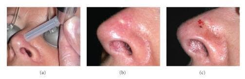 This composite of three clinical photographs documents a Photodynamic Therapy (PDT) procedure for a skin lesion on the lateral aspect of the nose. Frame (a) demonstrates the initial stage: needle-free intradermal administration of 20% Aminolevulinic Acid (ALA) using a MadaJet medical injector. The injector's clear nozzle is positioned against the nasal alar region. Frame (b) shows the immediate post-injection tissue response, characterized by localized erythema and slight edema at the delivery site, indicating successful penetration of the ALA solution. Frame (c) illustrates the skin's appearance following the full PDT procedure (red LED light illumination at 630 nm). The treatment area exhibits marked inflammatory changes, including prominent focal erythema and small areas of petechiae or superficial crusting, which are typical acute reactions to the photochemical process. This sequence illustrates a dermatological protocol for managing localized skin lesions, highlighting the transition from drug delivery to the immediate inflammatory phase of treatment.