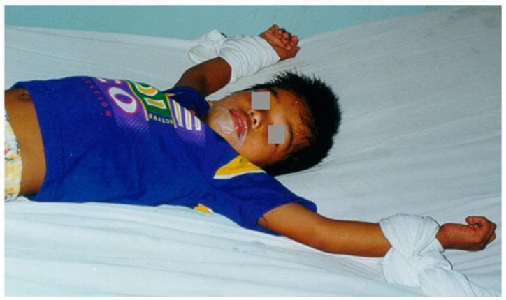 This clinical photograph displays a pediatric patient in a supine position on a white surface, illustrating the clinical manifestations of rabies encephalitis. A defining feature is the presence of thick, frothy salivary secretions around the mouth, a characteristic sign of autonomic dysfunction and pharyngeal spasms in rabies. The child's arms are abducted and secured with white cloth wrist restraints, a common clinical necessity to manage severe agitation or 'furious' symptoms associated with the disease progression. The image demonstrates the devastating presentation of encephalitic rabies and highlights the requirement for palliative management and safety protocols in advanced viral neuroinvasive diseases. Key educational concepts include rabies pathology, neurological agitation management, and infectious disease recognition.