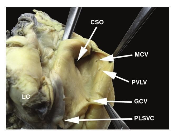 This clinical photograph of a dissected human heart specimen displays the internal anatomy of the coronary sinus and its associated venous tributaries. The primary feature is a significantly enlarged, funnel-shaped coronary sinus ostium (CSO). Positioned inferior to the CSO is the much smaller, rounded ostium of the great cardiac vein (GCV). The middle cardiac vein (MCV) and the posterior vein of the left ventricle (PVLV) are visible as smaller openings superior to the GCV. A critical anatomical variant, a persistent left superior vena cava (PLSVC), is shown draining into the coronary sinus from an inferior position. The specimen highlights the absence of the Thebesian valve at the CSO and the absence of the Vieussens valve at the GCV ostium. This image illustrates complex cardiac venous remodeling often associated with congenital anomalies like PLSVC, which can significantly alter the diameter and structure of the coronary sinus, holding importance for electrophysiological procedures and cardiac surgery.